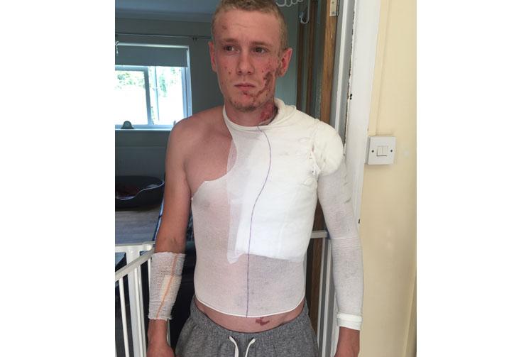 'He watched me burn' victims speaks of horrific acid attack by friend 